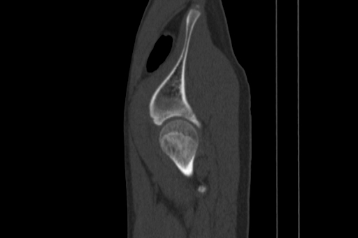 Anterior inferior iliac spine avulsion injury (Radiopaedia 88666-105376 Sagittal bone window 79).jpg