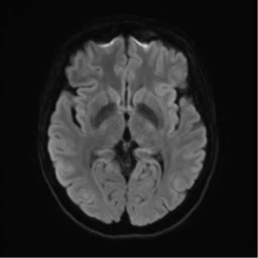 File:Anterior temporal lobe perivascular space (Radiopaedia 40946-43650 Axial DWI 40).png