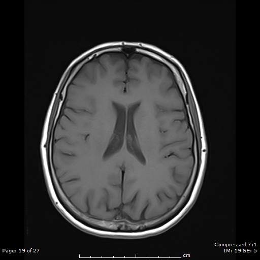 File:Anterior temporal lobe perivascular space (Radiopaedia 88283-104914 Axial T1 19).jpg
