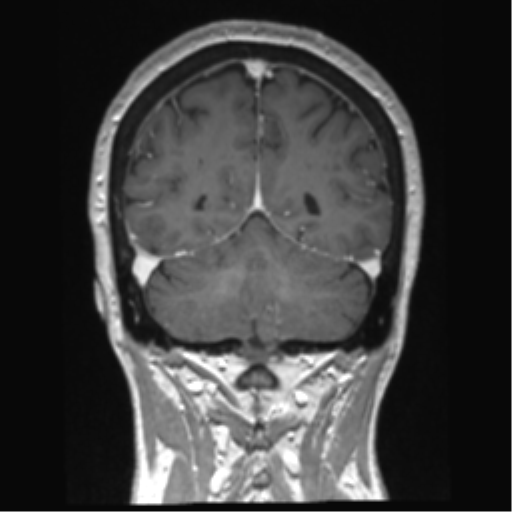 Anterior temporal pole cysts (Radiopaedia 46629-51102 Coronal T1 C+ 46).png