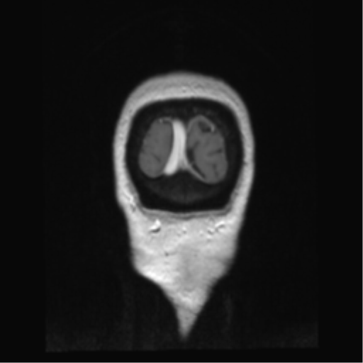 Anterior temporal pole cysts (Radiopaedia 46629-51102 Coronal T1 C+ 6).png