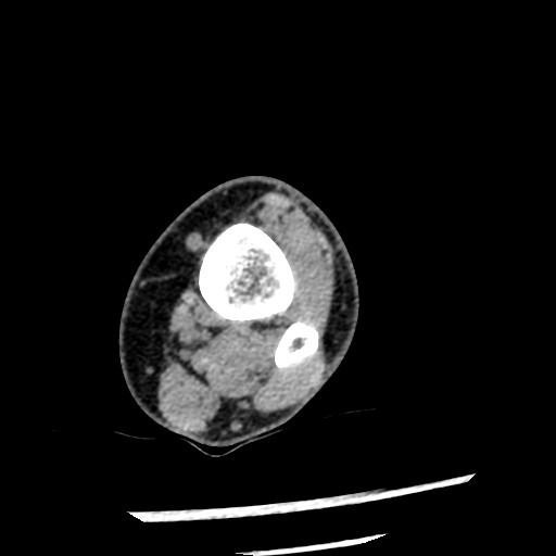 Anterior tibial artery false aneurysm (Radiopaedia 88984-105809 A 58).jpg
