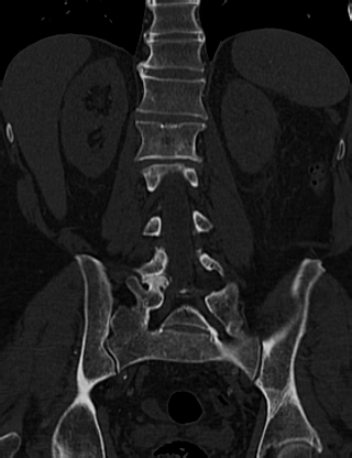 Anterior vertebral scalloping (abdominal aortic aneurysm) (Radiopaedia 66744-76067 Coronal bone window 44).jpg