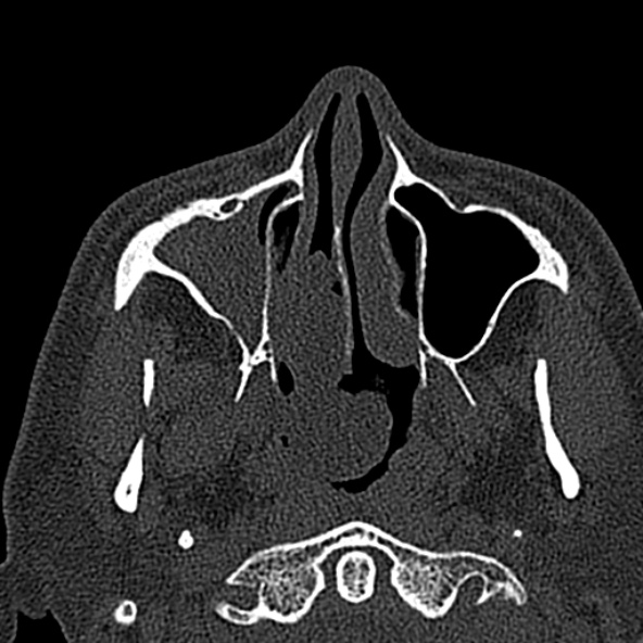Antrochoanal polyp (Radiopaedia 30002-30554 Axial bone window 21).jpg