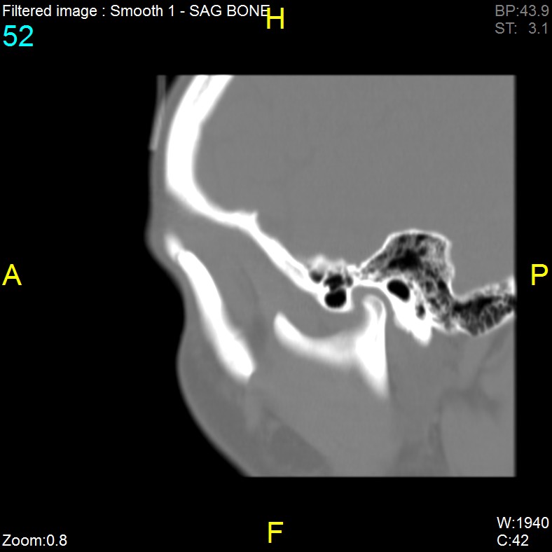 Antrochoanal polyp (Radiopaedia 65101-74094 Sagittal bone window 52).jpg