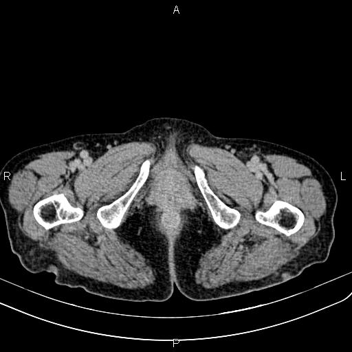 Aortic aneurysm and Lemmel syndrome (Radiopaedia 86499-102554 Axial C+ delayed 87).jpg
