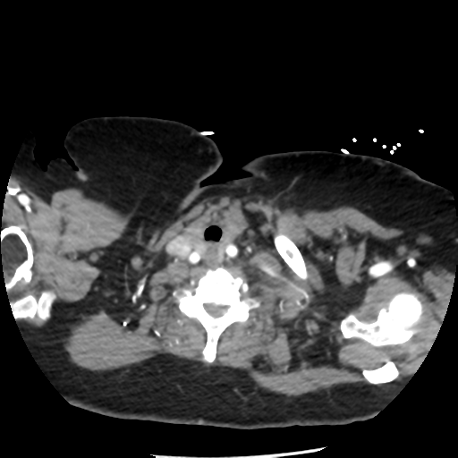 File:Aortic aneurysm and dissection - Stanford type A (Radiopaedia 36693-38261 A 6).png
