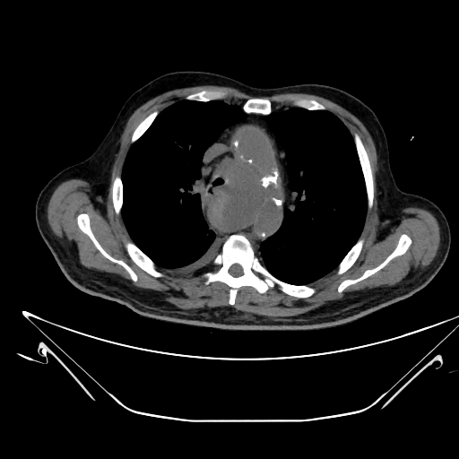 Aortic arch aneurysm (Radiopaedia 84109-99365 Axial non-contrast 104).jpg