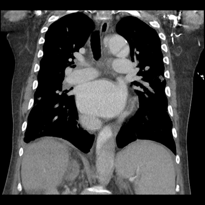 Aortic arch graft infection (FDG PET-CT) (Radiopaedia 71975-82437 Coronal 36).jpg
