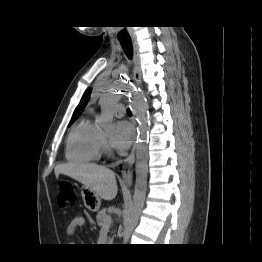 File:Aortic arch stent (Radiopaedia 30030-30595 B 11).jpg