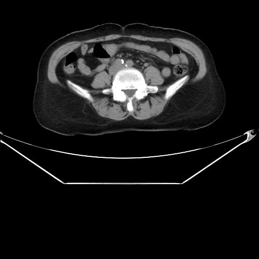 File:Aortic dissection (Radiopaedia 25350-25604 B 56).jpg