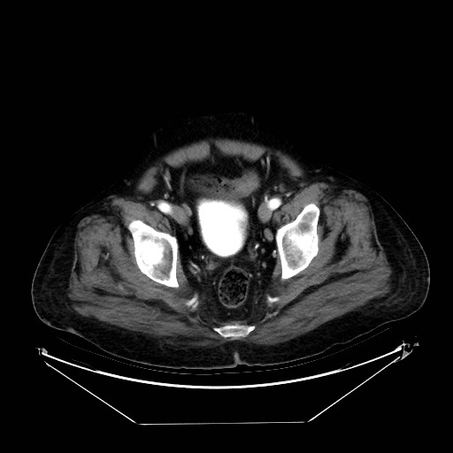 Aortic dissection (Radiopaedia 62562-71000 A 102).jpg