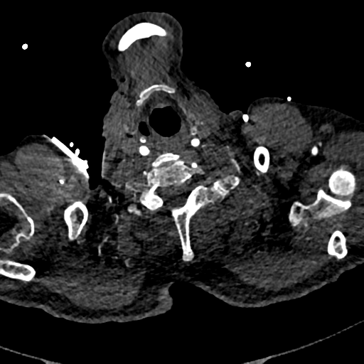 File:Aortic dissection - DeBakey type II (Radiopaedia 64302-73082 A 2).png