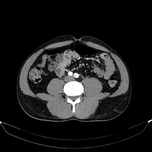 Aortic dissection - Stanford type A (Radiopaedia 83418-98500 A 89).jpg