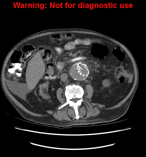 Aortic graft infection (Radiopaedia 44979-48907 Axial non-contrast 50).jpg