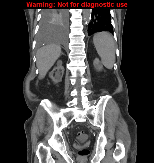 Aortic graft infection (Radiopaedia 44979-48907 non-contrast 37).jpg