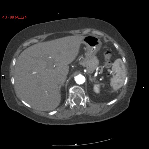 Aortic intramural hematoma (Radiopaedia 27746-28001 A 88).jpg
