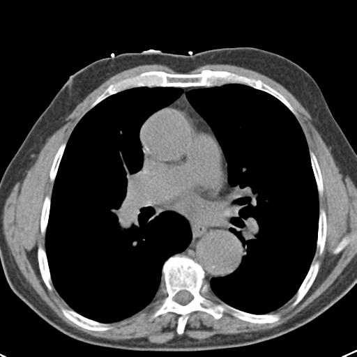 Aortic intramural hematoma (Radiopaedia 31139-31838 Axial non-contrast 28).jpg