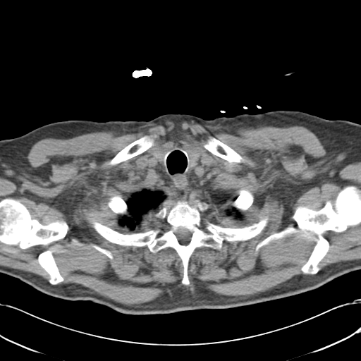 Aortic intramural hematoma (Radiopaedia 34260-35540 Axial non-contrast 6).png