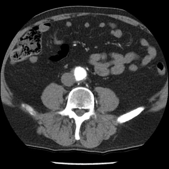 Aortic intramural hematoma (type B) (Radiopaedia 79323-92387 B 82).jpg