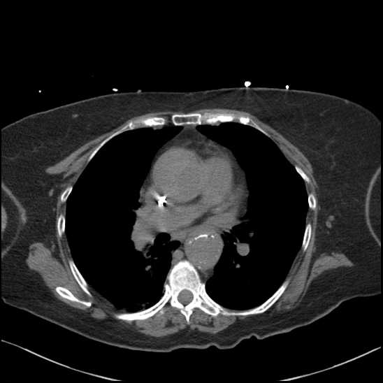 Aortic intramural hematoma with dissection and intramural blood pool (Radiopaedia 77373-89491 Axial non-contrast 47).jpg