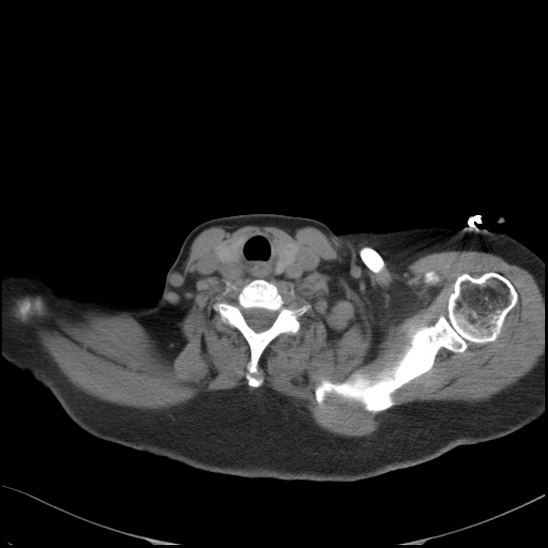 Aortic intramural hematoma with dissection and intramural blood pool (Radiopaedia 77373-89491 Axial non-contrast 6).jpg
