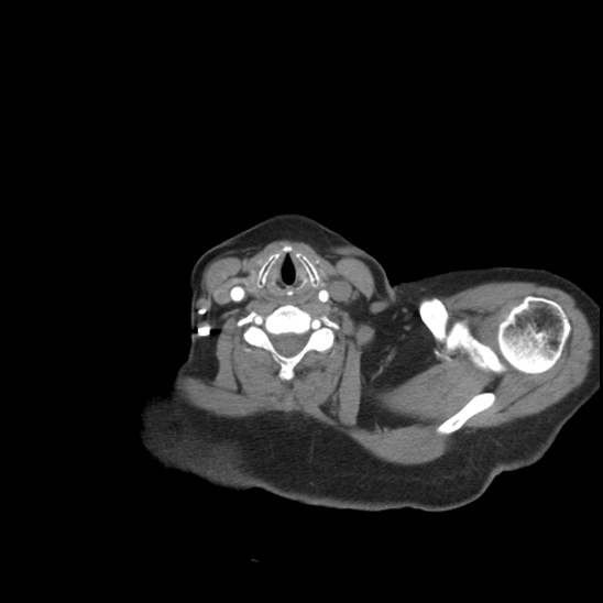 Aortic intramural hematoma with dissection and intramural blood pool (Radiopaedia 77373-89491 B 13).jpg