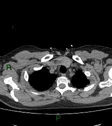 Aortic valve endocarditis (Radiopaedia 87209-103485 Axial non-contrast 17).jpg