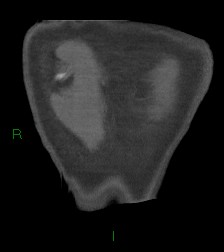 File:Aortic valve endocarditis (Radiopaedia 87209-103485 D 1).jpg