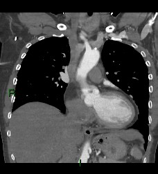 Aortic valve endocarditis (Radiopaedia 87209-103485 D 40).jpg