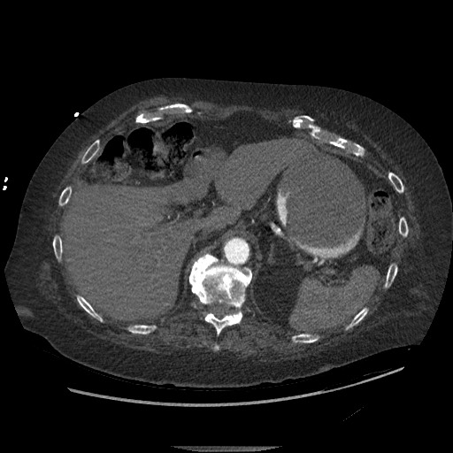 Aortoesophageal fistula with endovascular repair (Radiopaedia 73781-84592 Axial C+ CTPA 170).jpg