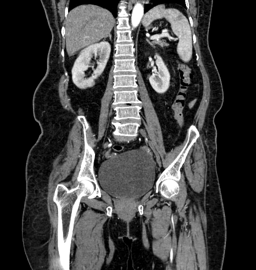 Aortoiliac occlusive disease (Radiopaedia 52352-58248 B 39).jpg