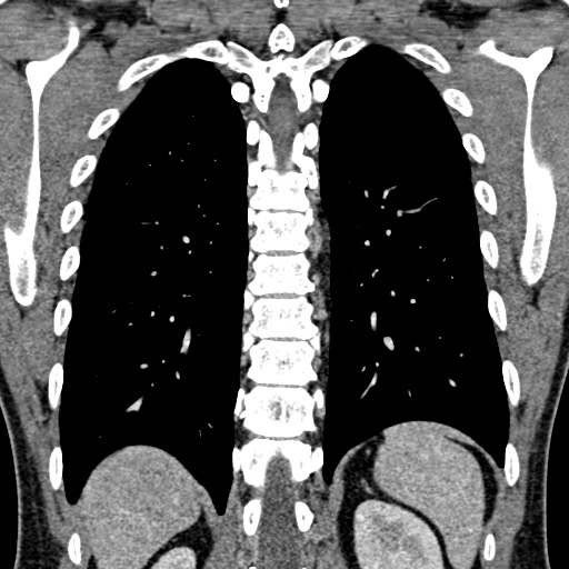 Apical lung mass mimic - neurogenic tumor (Radiopaedia 59918-67521 B 81).jpg