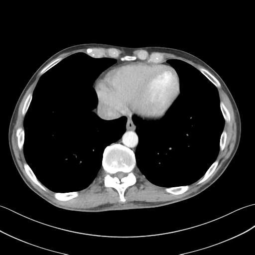 File:Apical pleural calcification (Radiopaedia 46141-50499 Axial C+ delayed 53).png