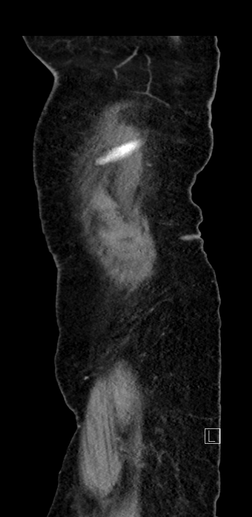 Appendiceal hemorrhage (Radiopaedia 70830-81025 Sagittal C+ delayed 8).jpg