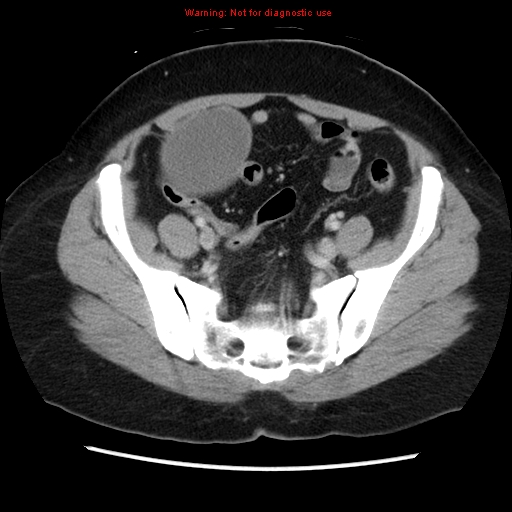 Appendiceal mucinous cystadenoma (Radiopaedia 8263-9111 Axial liver window 63).jpg