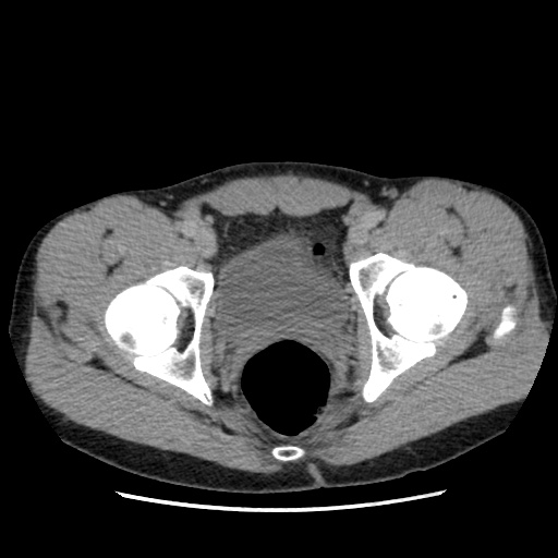 File:Appendicitis complicated by post-operative collection (Radiopaedia 35595-37113 A 74).jpg