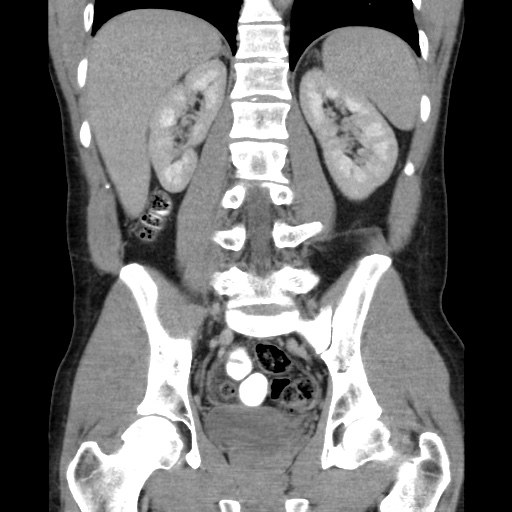 File:Appendicitis complicated by post-operative collection (Radiopaedia 35595-37113 B 36).jpg