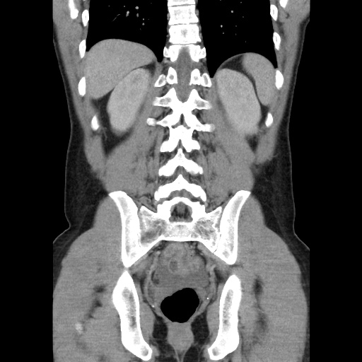 Appendicitis complicated by post-operative collection (Radiopaedia 35595-37114 B 41).jpg