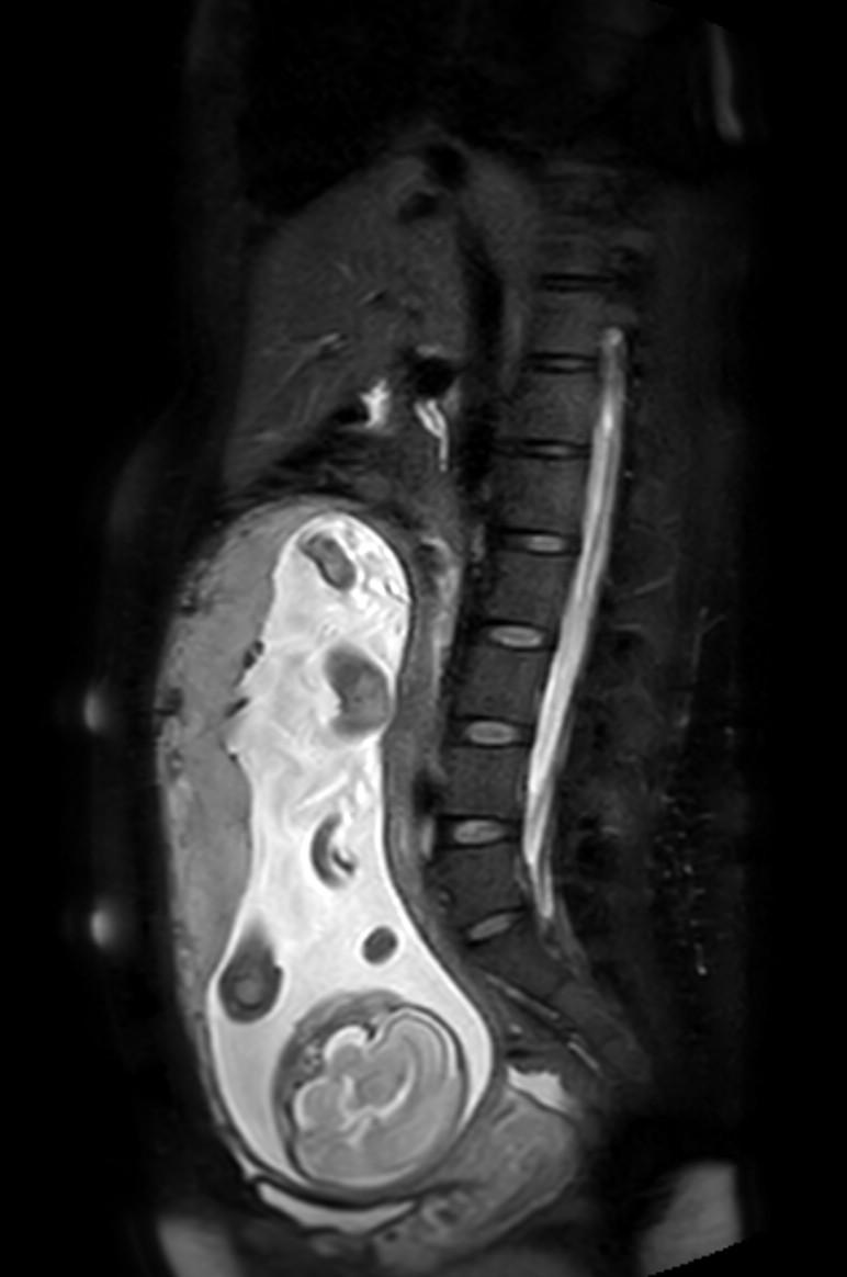 Appendicitis in gravida (MRI) (Radiopaedia 89433-106395 Sagittal T2 SPAIR 33).jpg