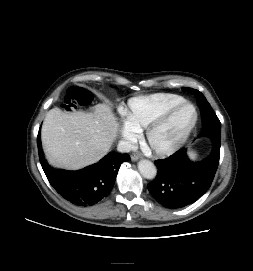 File:Appendicitis with localized perforation and abscess formation (Radiopaedia 49035-54130 A 15).jpg