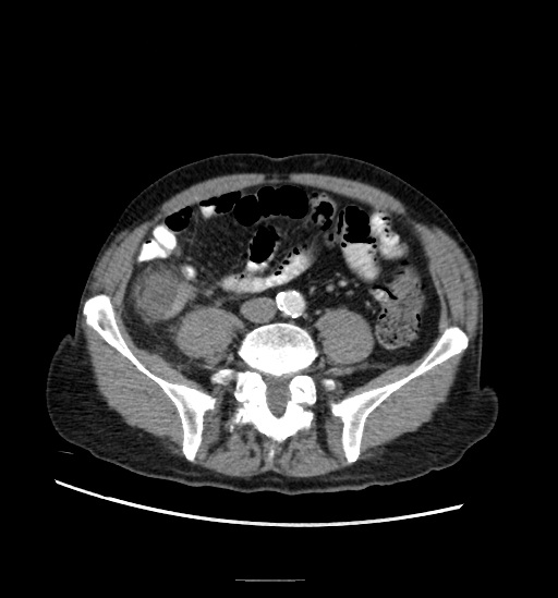 Appendicitis with localized perforation and abscess formation (Radiopaedia 49035-54130 A 60).jpg