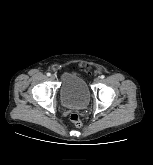Appendicitis with localized perforation and abscess formation (Radiopaedia 49035-54130 A 80).jpg
