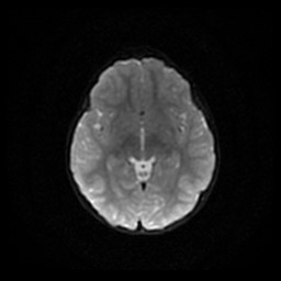 Arachnoid cyst - middle cranial fossa (Radiopaedia 86780-102938 Axial DWI 45).jpg