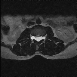 File:Arachnoid cyst - spinal (Radiopaedia 66835-76157 Axial T2 14).jpg