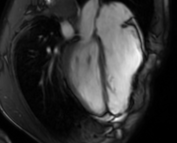 Arrhythmogenic right ventricular cardiomyopathy (Radiopaedia 69564-79464 4ch cine 95).jpg