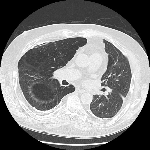 Asbestos-related pleural disease (Radiopaedia 74366-85250 Axial lung window 58).jpg
