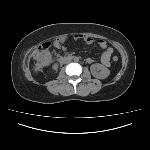 Ascending retrocecal appendicitis with liver abscesses (Radiopaedia 60066-67615 Axial non-contrast 43).jpg