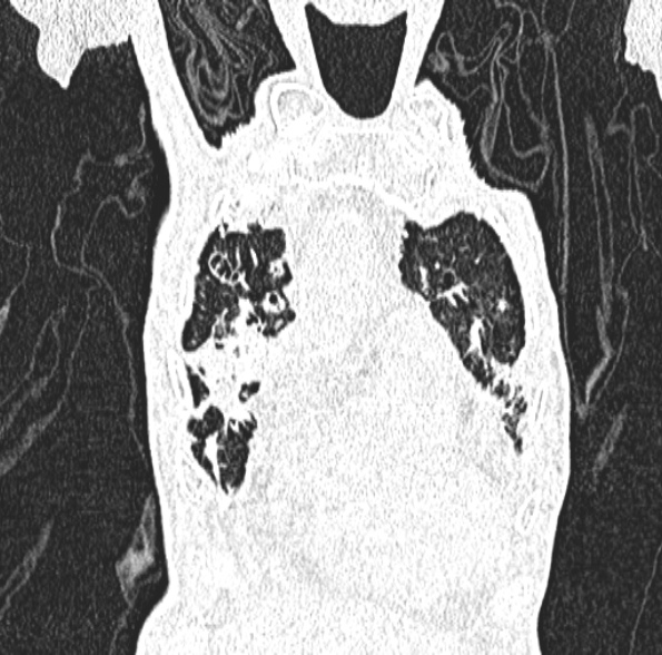File:Aspergilloma- with Monod sign (Radiopaedia 44737-48532 Coronal lung window 144).jpg