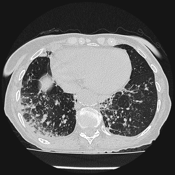 Aspergilloma (Radiopaedia 24458-24763 Axial lung window 52).jpg
